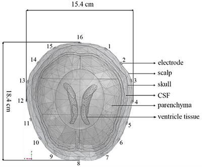 Suppressing interferences of EIT on synchronous recording EEG based on comb filter for seizure detection